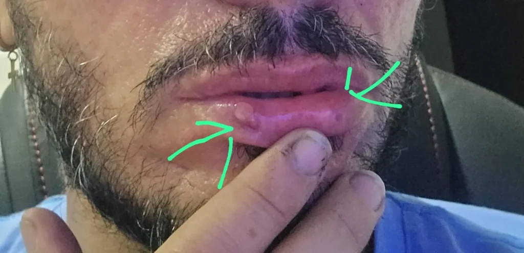 David Potro mostra as lesoes na boca atribuidas a Esfera de Buga arquivo pessoal