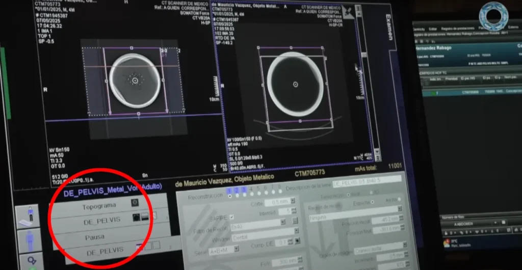 Ovni Esfera de Buga: mais análises improvisadas, misturadas com teorias mirabolantes 6 Equipamento de tomografia computadorizada mostra na tela padrões de uso para humanos, não análises industriais (Reprodução/Youtube/Maussan Television)