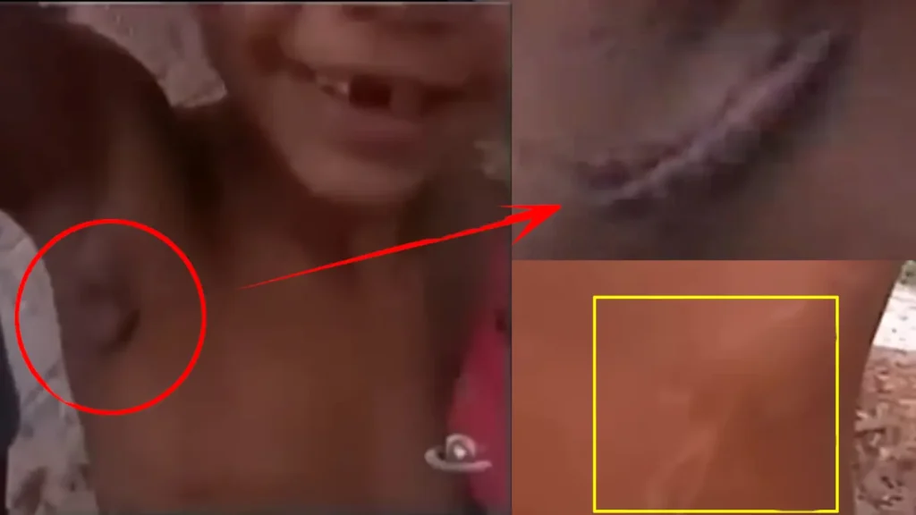 Caso Janiel: o menino de Itarema (CE) que relatou um ataque brutal por seres desconhecidos 2 Na axila de Janiel, a grande cicatriz do profundo ferimento causado pelo suposto ser. Nas costas, mais marcas do ataque (Imagens - Agobar Peixoto, Reprodução Mistérios dos 190 - CNEWS)